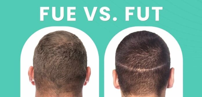 FUE vs FUT, hair transplant methods, FUE hair transplant benefits, FUT hair transplant, best hair transplant technique India, MedLinks hair restoration, FUE vs strip method, hair loss treatment India